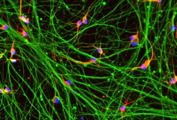 헌팅턴 신경세포 | Huntington HTT50CAG cell 이미지